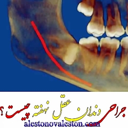 جراحی دندان عقل نهفته چیست؟