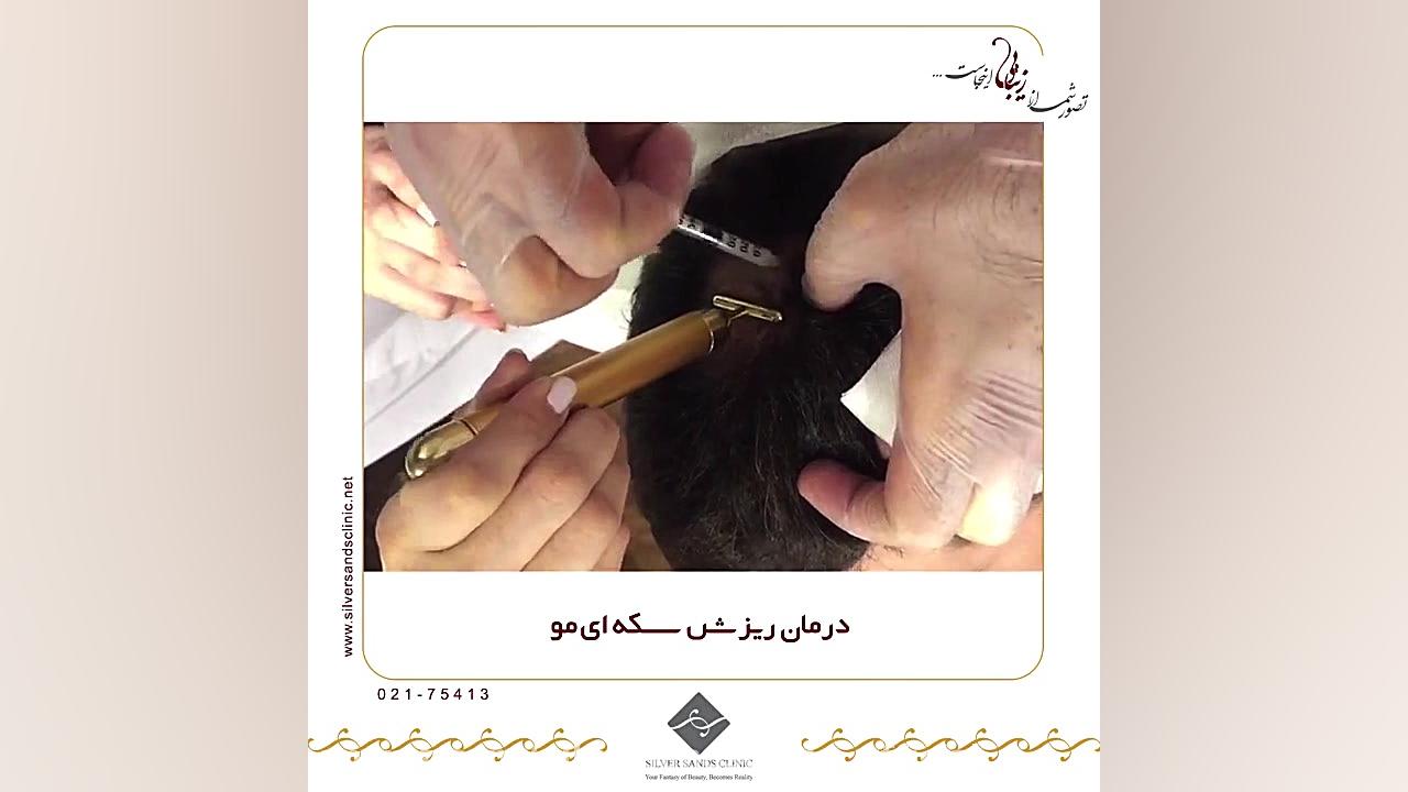 درمان ریزش سکه ای مو ناتالی پورتمن
