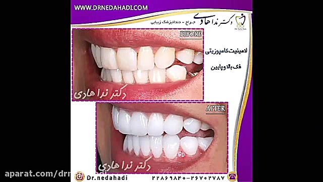 نمونه كارهای لمینت دندان | دکتر ندا هادی جراح و دندانپزشک زیبایی دکتر ندا هادی-دندانپزشک زیبایی