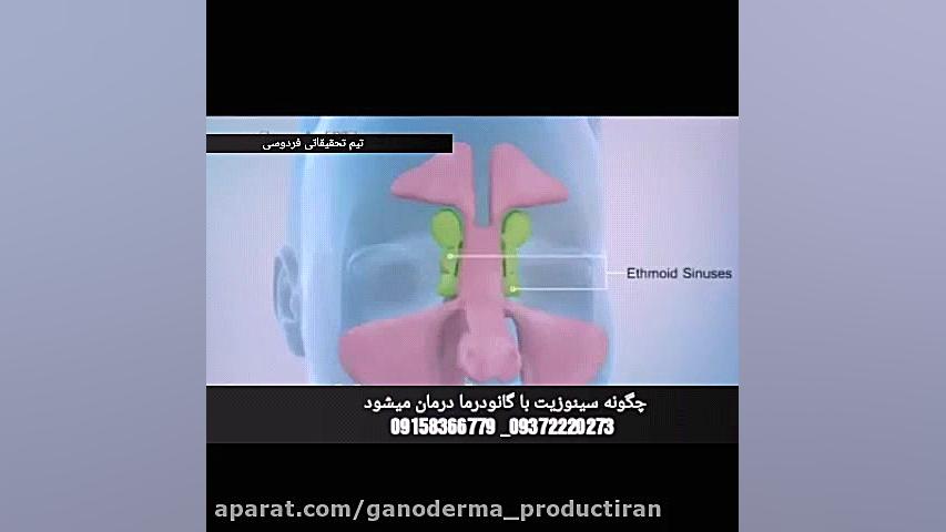 درمان قطعی سینوزیت توسط گانودرما میگرن سردرد عفونت رفع غبغب