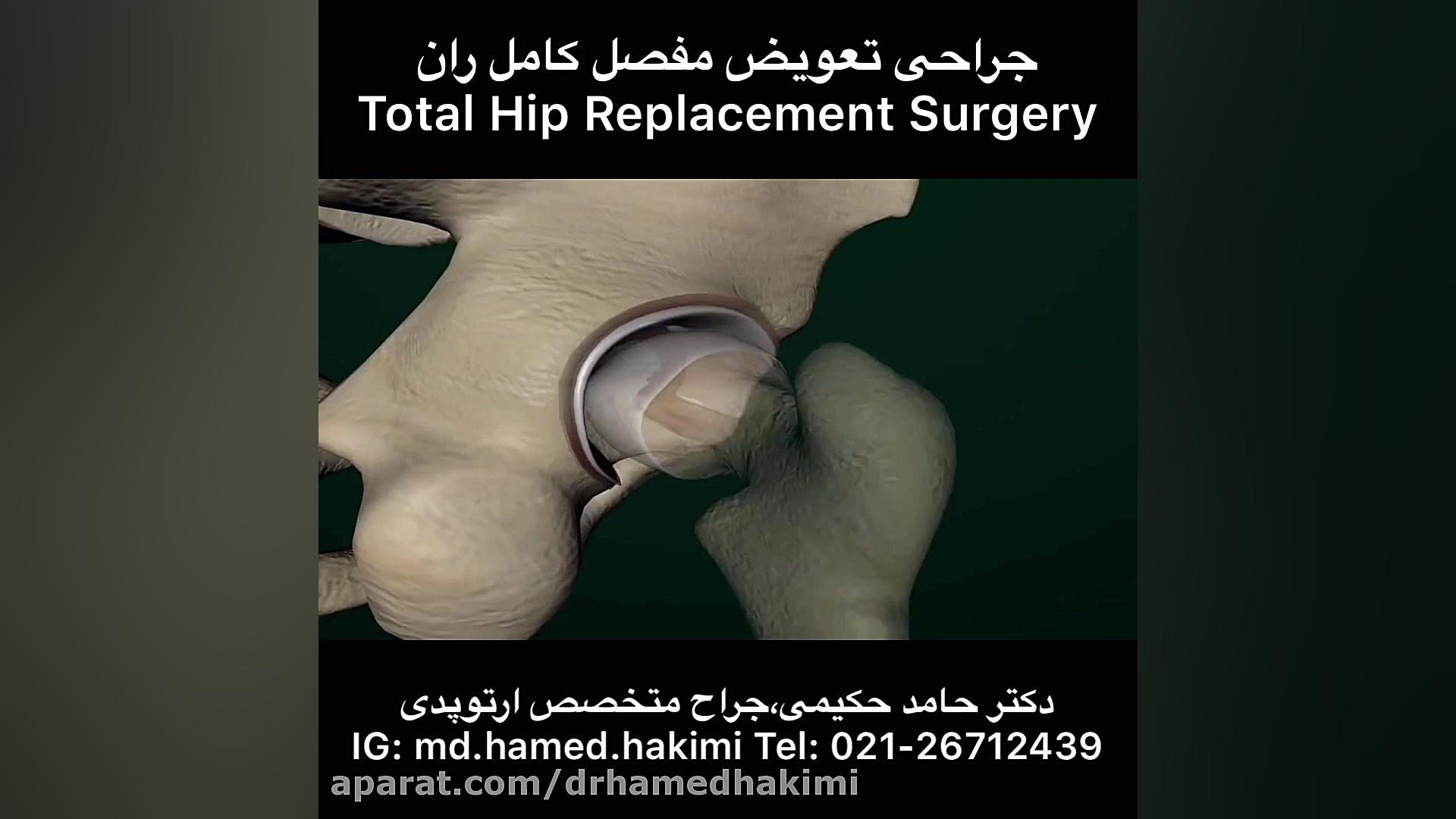 جراحی تعویض مفصل ران(لگن)،دکتر حامد حکیمی،پزشک جراح متخصص ارتوپدی جرمگیری