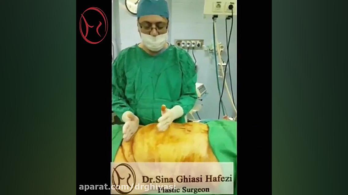فیلم ابدومینوپلاستی دکتر غیاثی دکتر سینا غیاثی حافظی