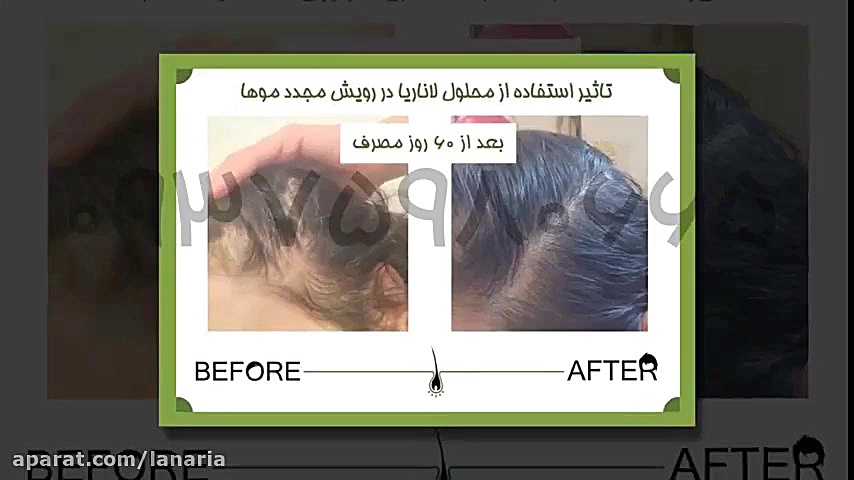 درمان ریزش مو در زنان با پکیج دکتر نوروزیان علامت بابینسکی