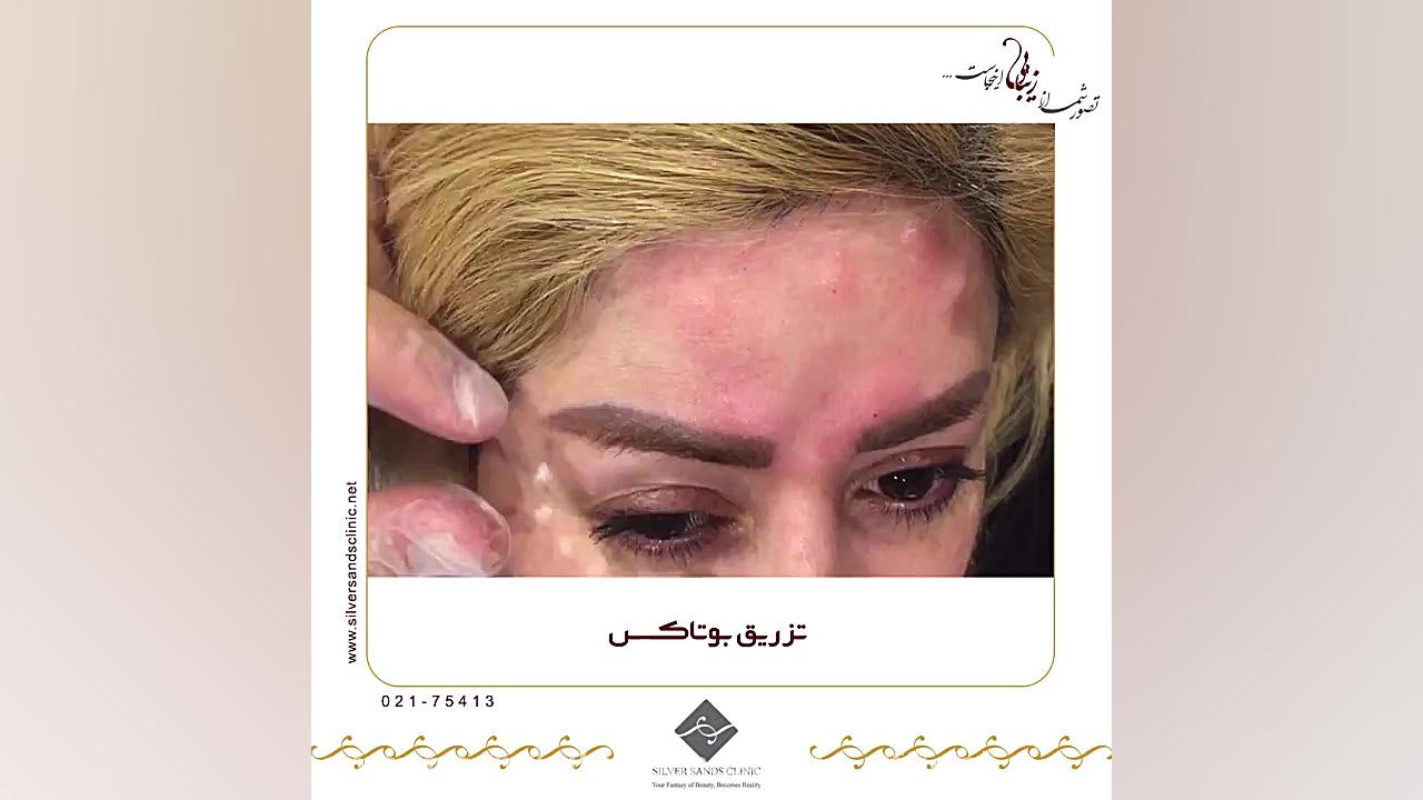 تزریق بوتاکس قارچ‌شناسی پزشکی