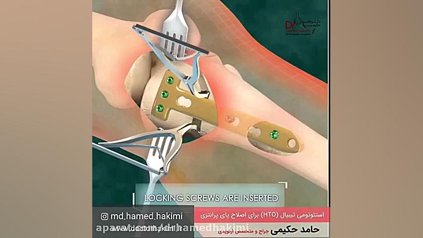 جراحی استئوتومی جهت اصلاح پای پرانتزی،دکتر حامد حکیمی،پزشک جراح متخصص ارتوپدی کربوکسی تراپی