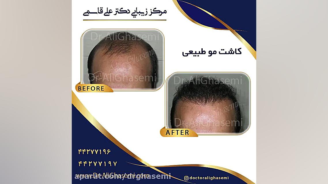نمونه کار کاشت ابرو ، کاشت مژه ، کاشت مو دکتر علی قاسمی(پوست ، مو ، زیبایی )