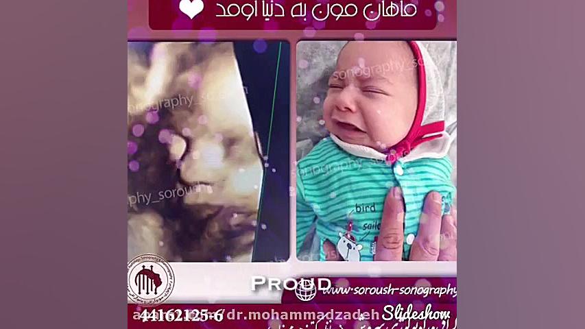 سونوگرافی جنین استوری فشفشه‌ای