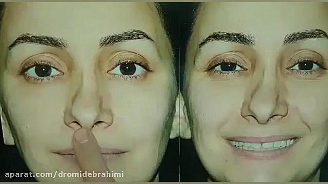جراحی ترمیمی بینی، دکتر امید ابراهیمی بهترین جراح بینی دکتر امید ابراهیمی