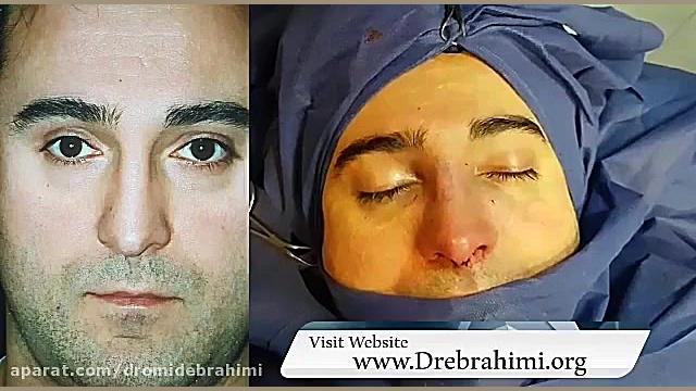 عمل بینی استخوانی توسط دکتر امید ابراهیمی بهترین جراح بینی دکتر امید ابراهیمی