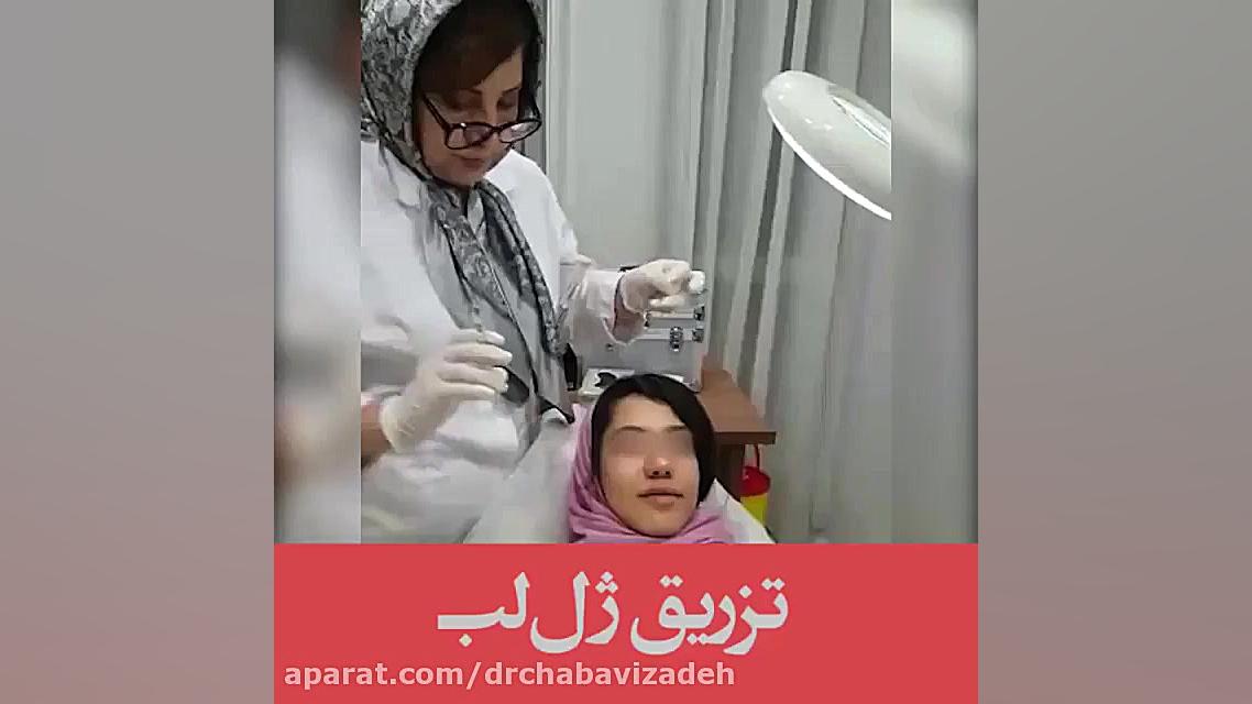تزریق ژل لب | دکتر صفیه چعباوی زاده متخصص پوست، مو و زیبایی دکتر صفیه چعباوی زاده