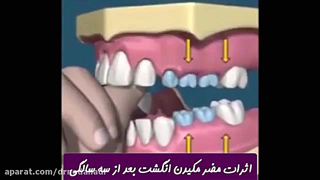 مضرات مکیدن انگشت بعد از سه سالگی | دکتر ندا هادی جراح و دندانپزشک زیبایی دکتر ندا هادی-دندانپزشک زیبایی