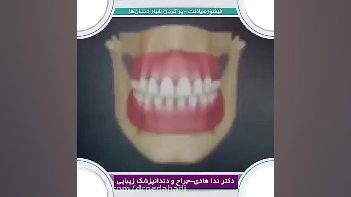 نحوه ی پر كردن شیار دندان ها | دکتر ندا هادی جراح و دندانپزشک زیبایی دکتر ندا هادی-دندانپزشک زیبایی