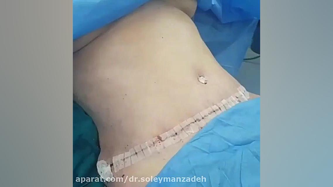 ابدومینو پلاستی و پیکر تراشی لیپوماتیک | دکتر پژوا سلیمان زاده بیماری مایکلیناپاتی