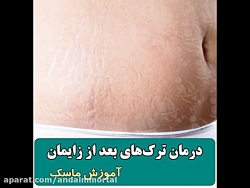 درمان قطعی ترکهای بارداری و چا...