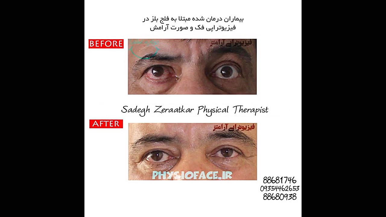فیزیوتراپیست صادق زراعتکار، فلج بلز صورت تزریق ژل