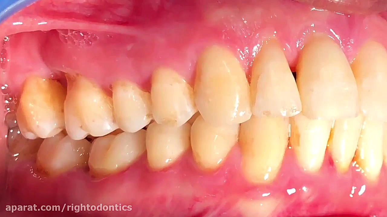 آیا ارتودنسی بعد از جراحی لثه ممکن است؟ تست تراشه ژنی
