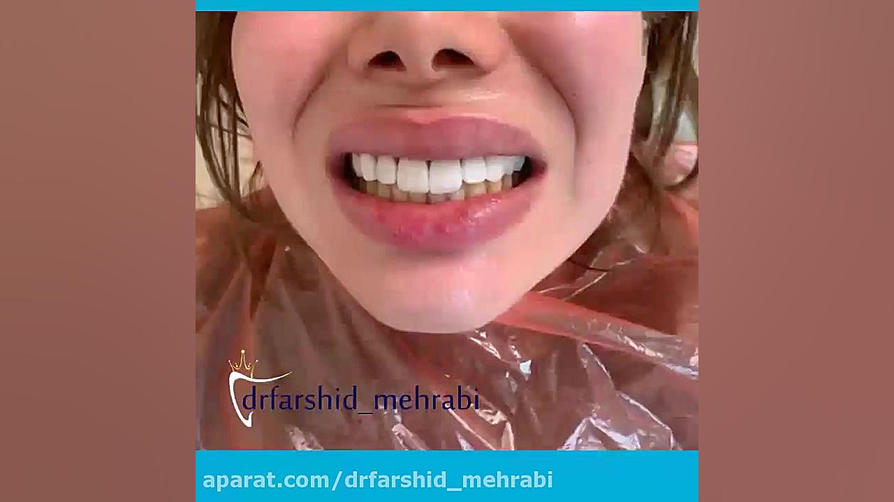 فیلم لمینت دندان | لمینیت دندان مایکروگناتیا