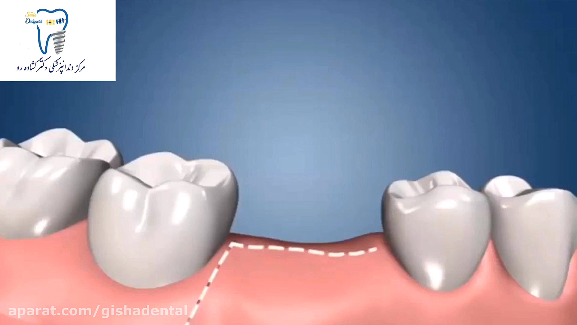 همه چیز در مورد ایمپلنت دندان کلینیک دندانپزشکی دکتر عزیز گشاده رو