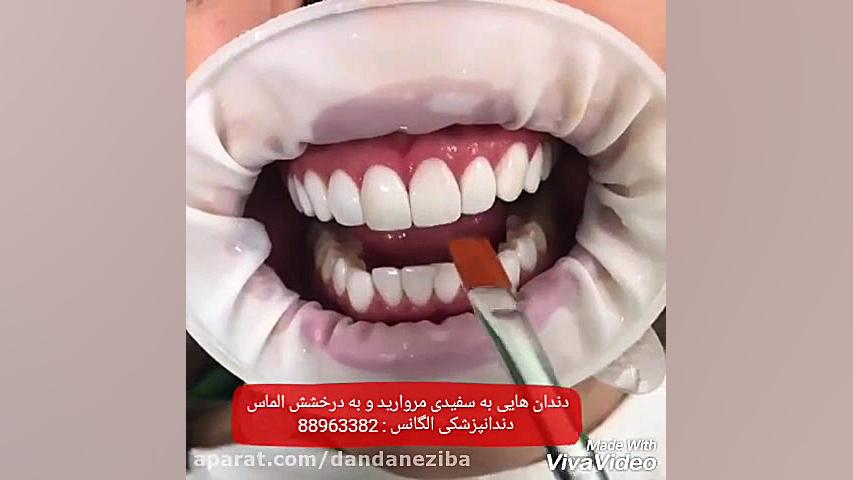 فیلم چسباندن ونیر کامپوزیت | چسباندن لمینیت سرامیکی | چسباندن روکش دندان پزشکی دریایی