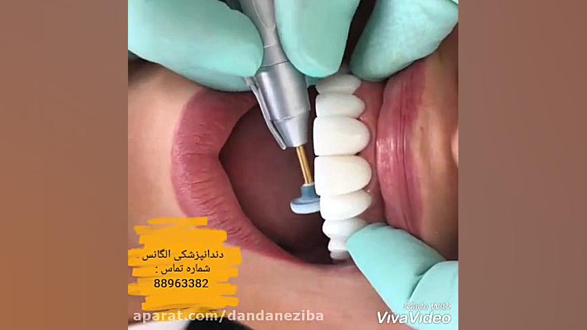 بهترین دندانپزشک زیبایی | بهترین دندانپزشک ترمیمی | بهترین متخصص لمینیت لیپوست