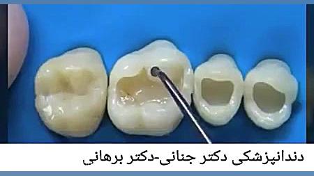 پرکردن همرنگ دندان های خلفی (راهی برای داشتن دندان های زیبا) scATAC-Seq