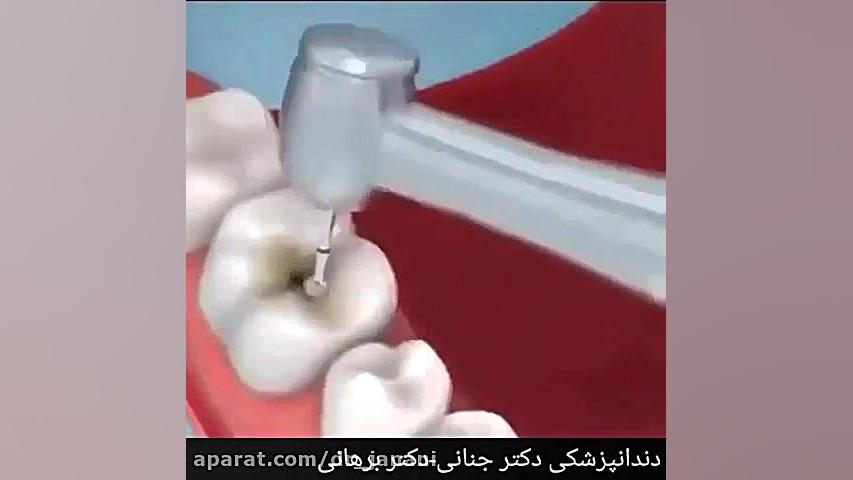 ترمیم پوسیدگی دندان با کامپوزیت های زیبایی بیماری دیستروفی لیمب-گیرل
