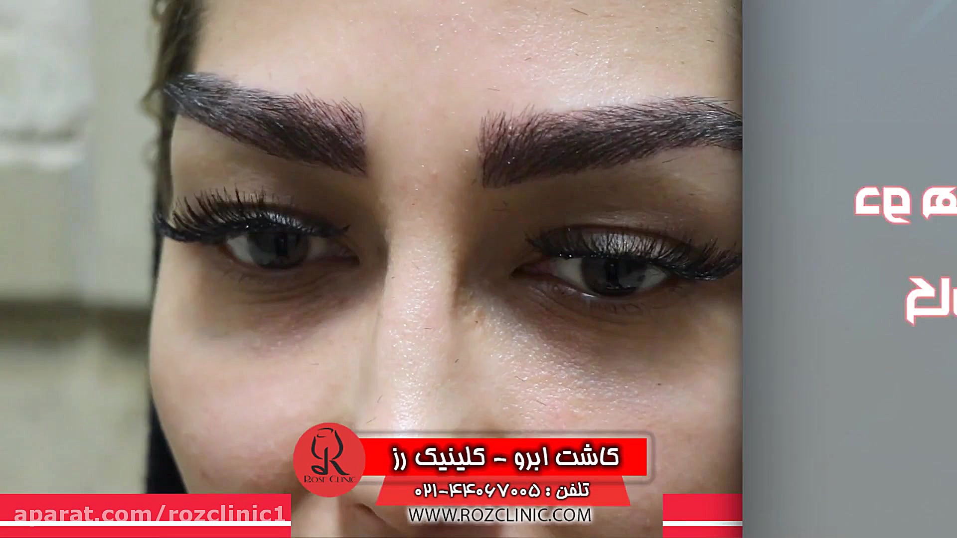 کاشت ابرو | فیلم کاشت ابرو | کلینیک پوست و مو رز | شماره106 لنز تماسی دارورسان
