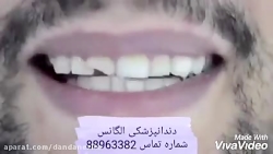 علت شکستن لمینیت سرامیکی | مان...