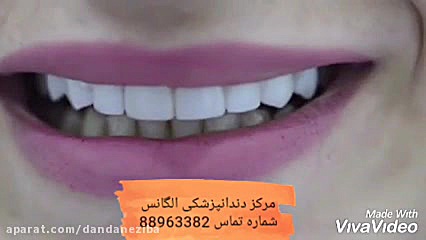 بلیچینگ دندان | سفید کردن دندان | کاشت نگین دندان | بروساژ دندان | جرمگیری دندان Organoid Viability Test