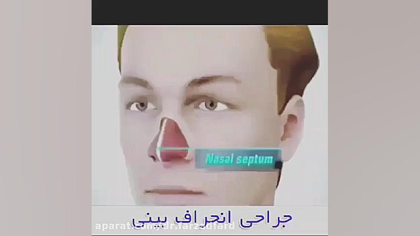 عملیه انحراف الانف دکتر اسماعیل فرزاد فرد - فوق تخصص پلاستیک