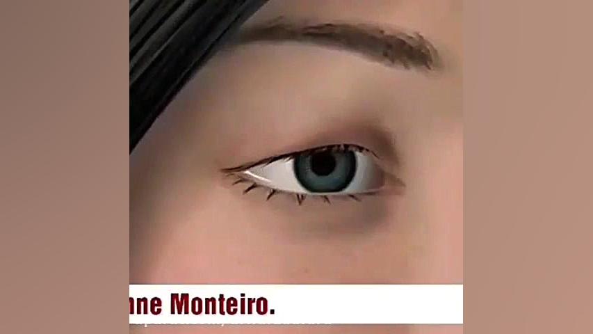 جراحه تجمیلیه الجفن دکتر اسماعیل فرزاد فرد - فوق تخصص پلاستیک