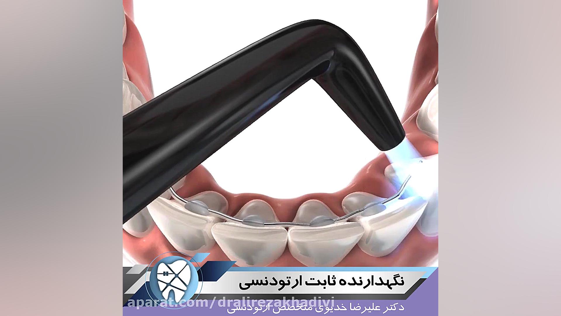 نگه دارنده ثابت ارتودنسی دکتر علیرضا خدیوی