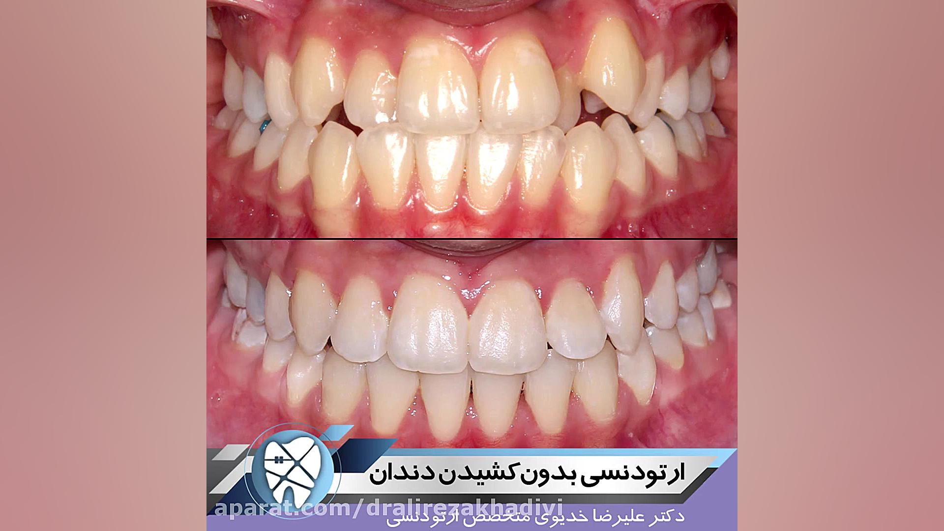 ارتودنسی بدون کشیدن دندان دکتر علیرضا خدیوی