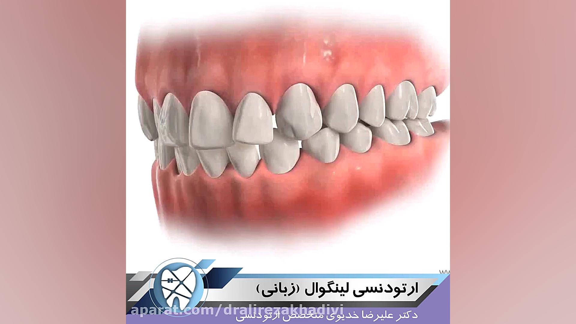 ارتودنسی لینگوال دکتر علیرضا خدیوی