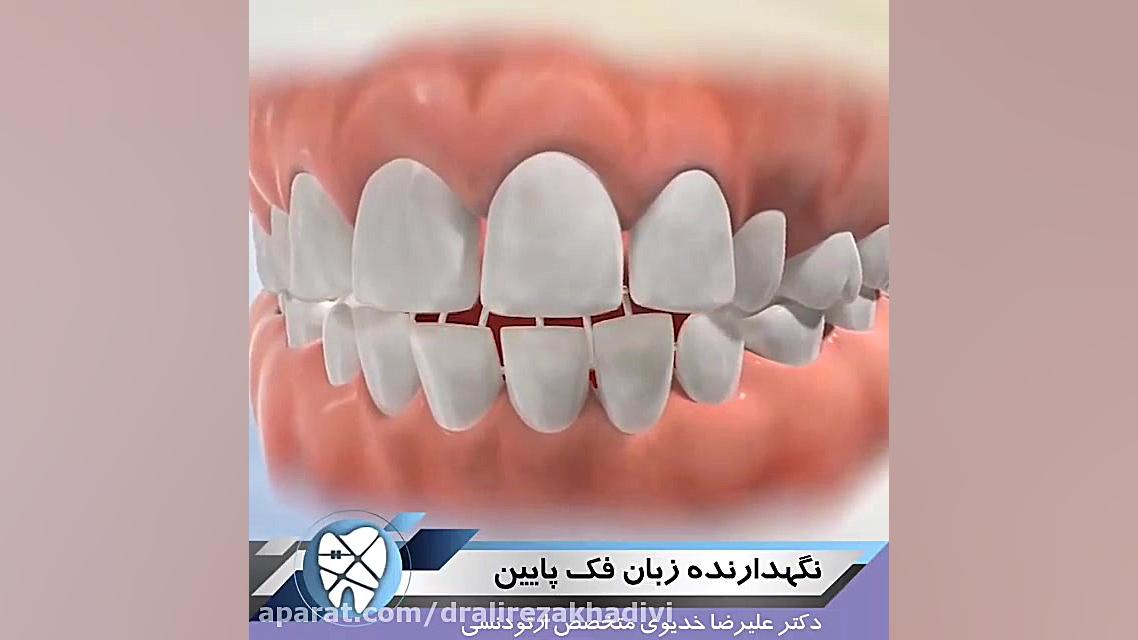 نگهدارنده زبان فک پایین دکتر علیرضا خدیوی