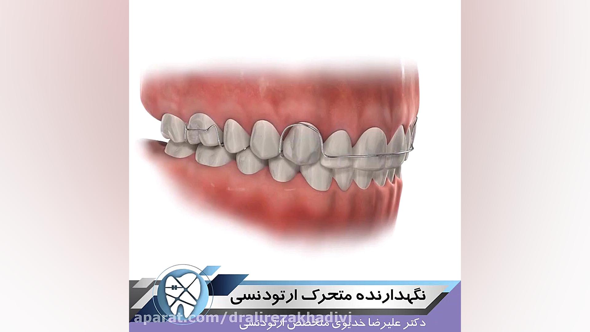 نگهدارنده متحرک ارتودنسی دکتر علیرضا خدیوی