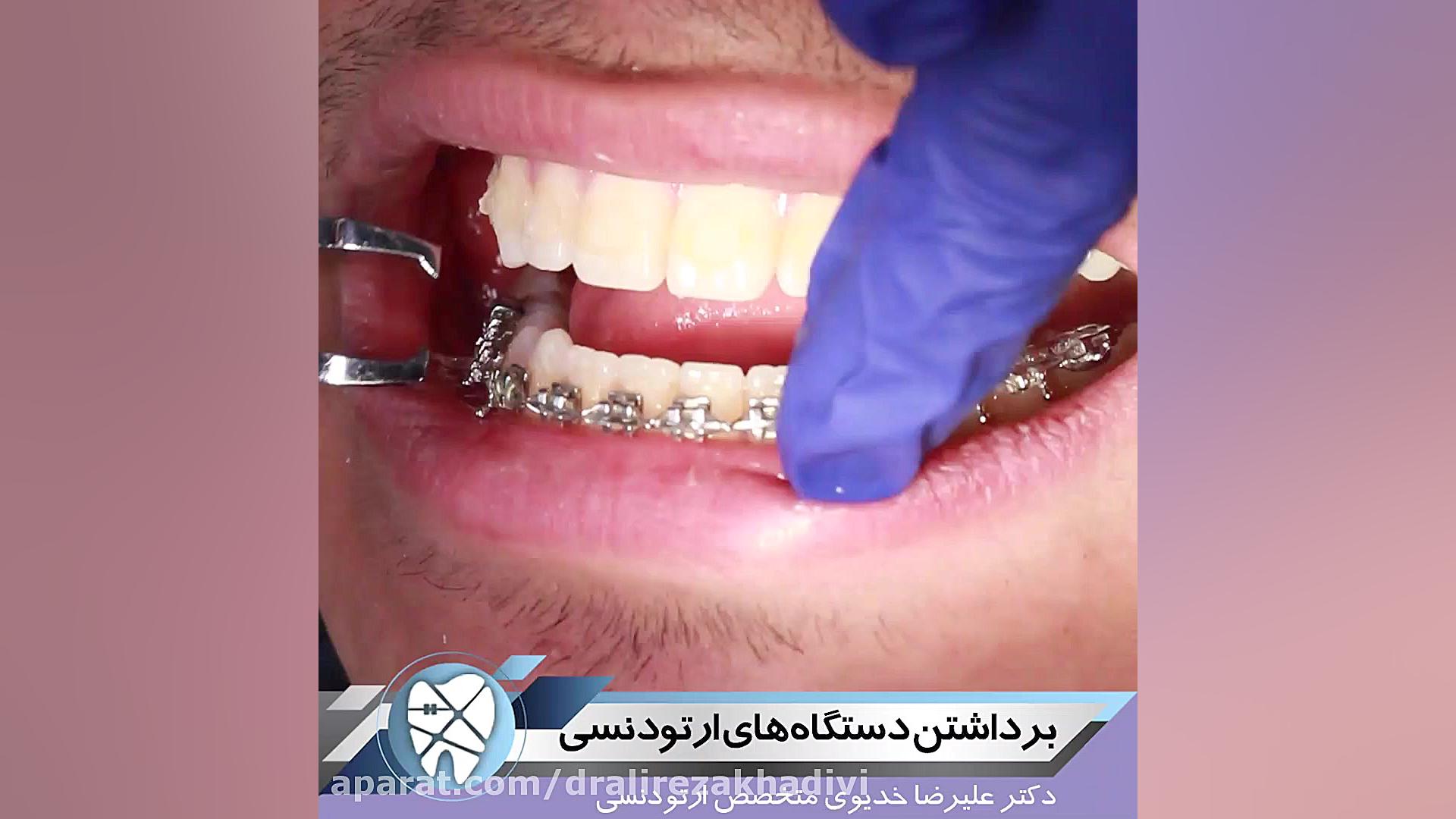 برداشتن دستگاه ارتودنسی دکتر علیرضا خدیوی