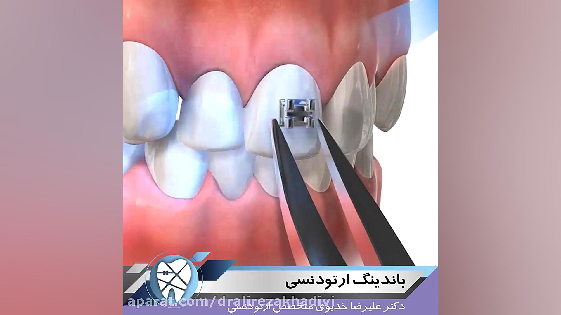 باندینگ ارتودنسی دکتر علیرضا خدیوی