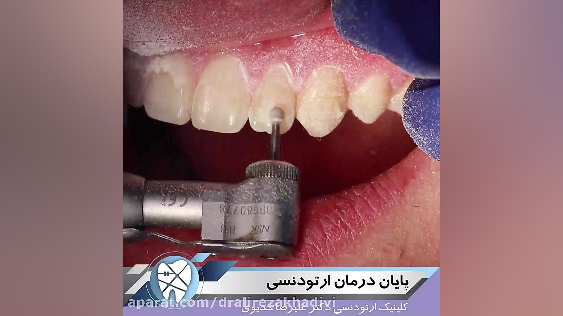 پایان درمان ارتودنسی دکتر علیرضا خدیوی