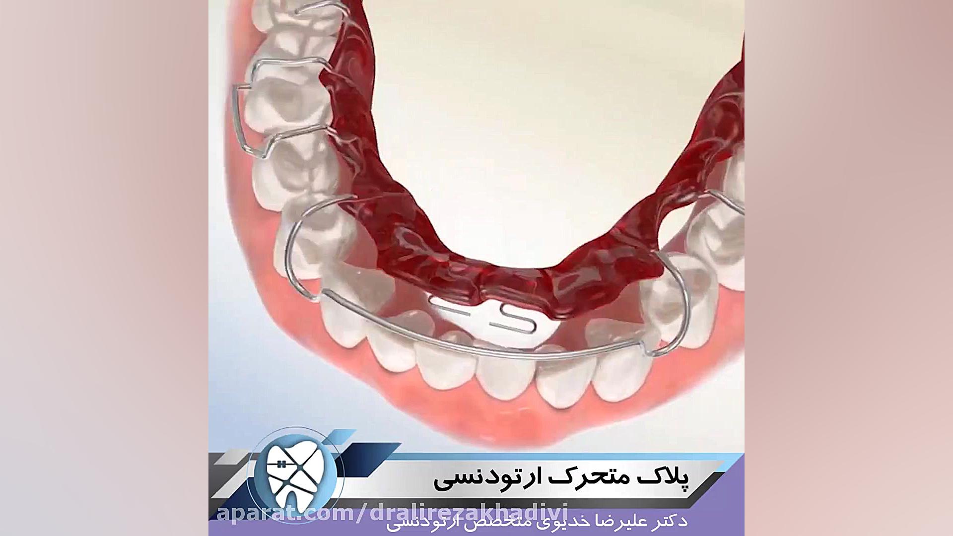 پلاک متحرک ارتودنسی دکتر علیرضا خدیوی