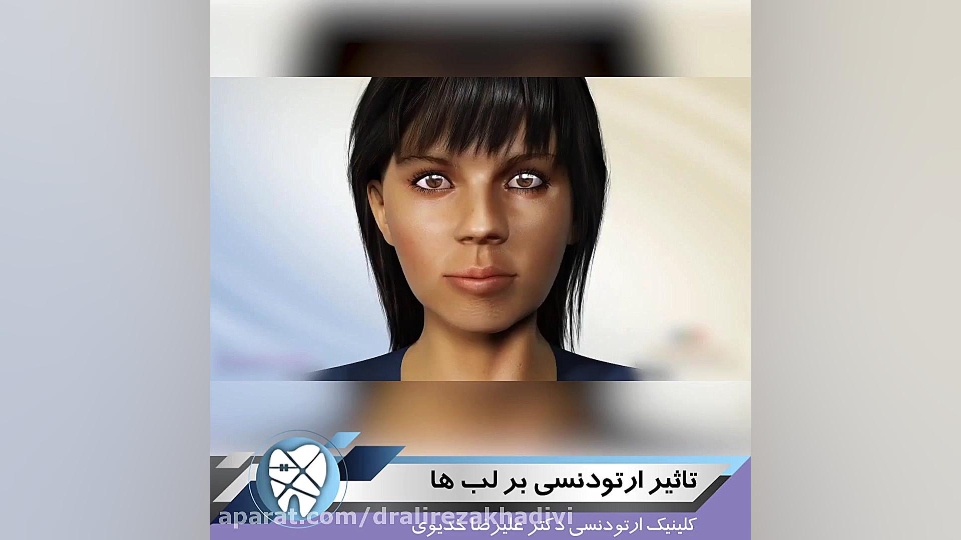 تاثیر ارتودنسی بر لب دکتر علیرضا خدیوی