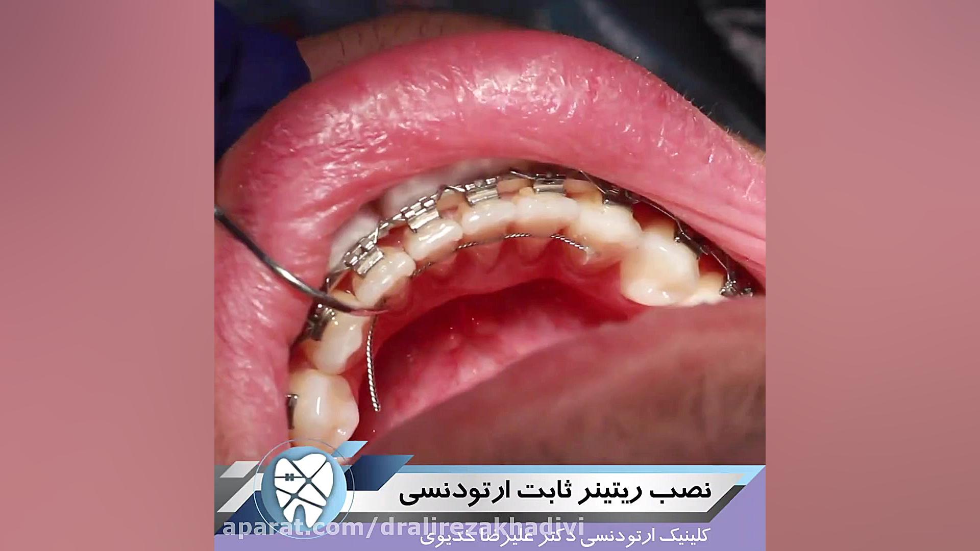نصب ریتینر ثابت ارتودنسی PVRژنتیک پزشکی پیشرفته