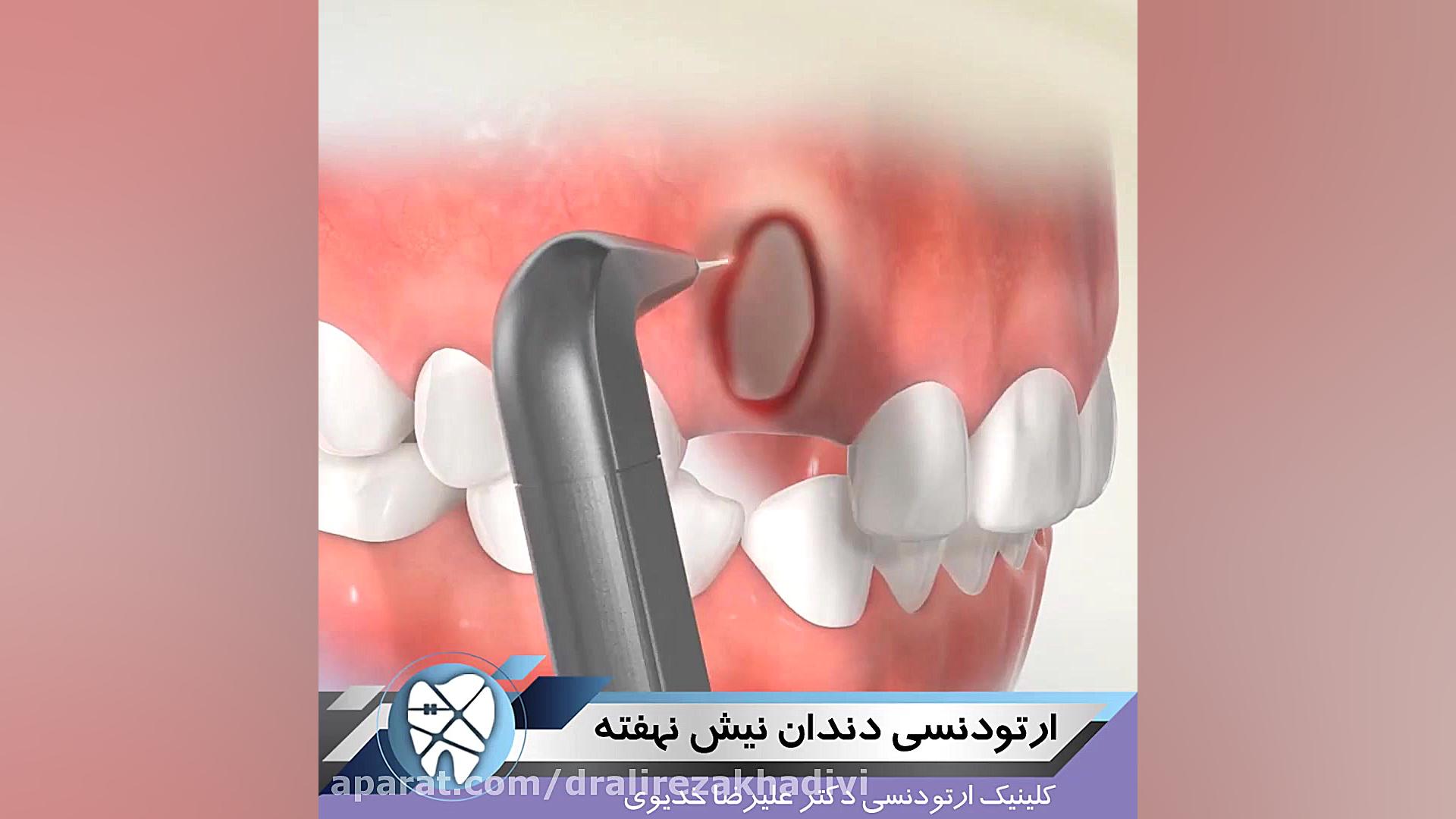 ارتودنسی دندان نیش نهفته دکتر علیرضا خدیوی