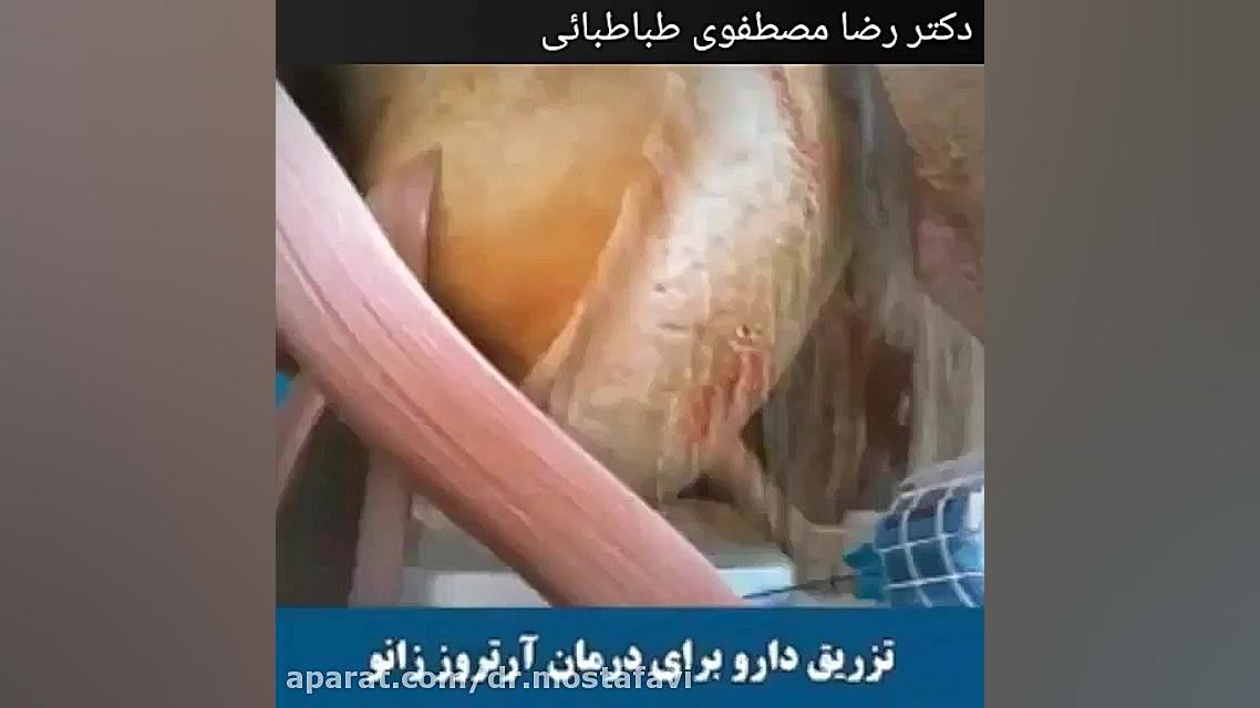 تزریق دارو برای درمان آرتروز زانو تزریق ژل