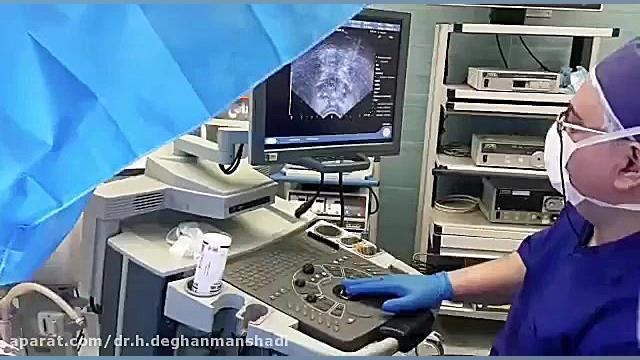 براکی تراپی سرطان پروستات دکتر حمیدرضا دهقان منشادی