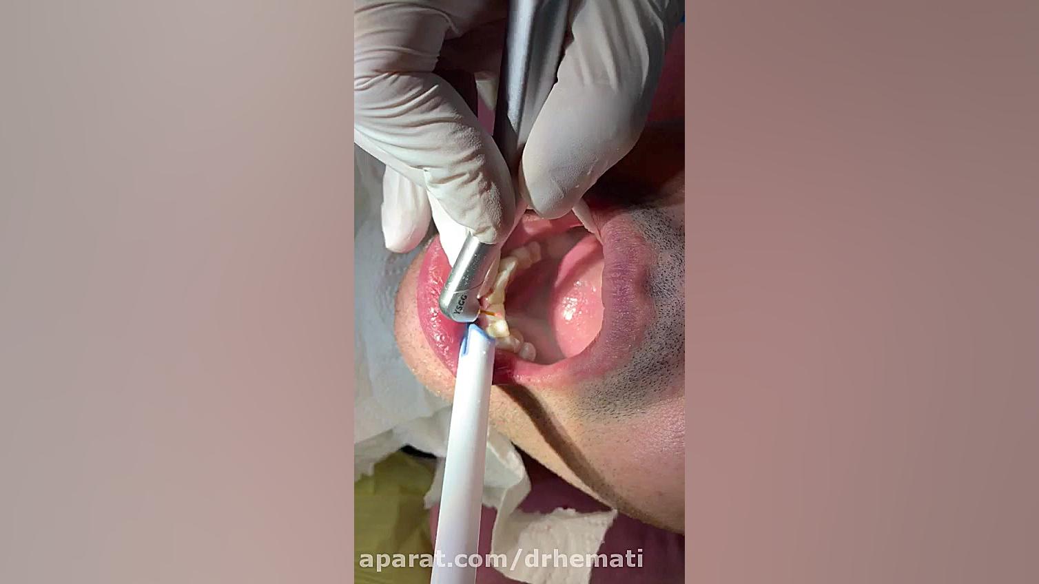 تفاوت لمینیت خوب و بد براساس مقاومت دربرابر لیزر. قسمت ۳ کانال دکتر مهران همتی. دندانپزشک