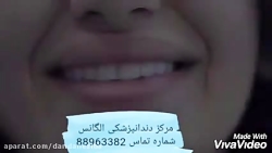 علت تغییر رنگ ونیر کامپوزیت |...