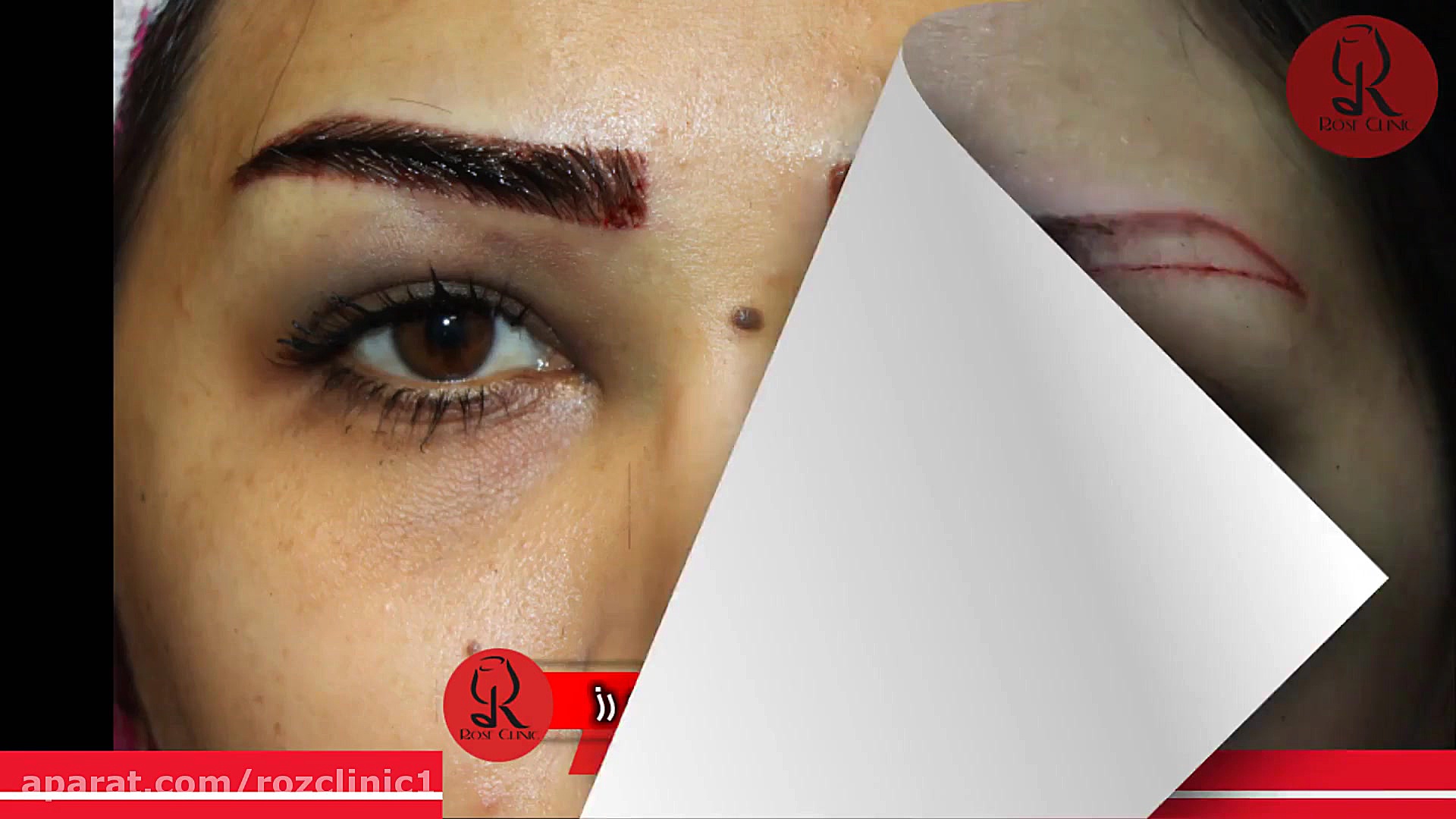 کاشت ابرو | فیلم کاشت ابرو | کلینیک پوست و مو رز | شماره109 ترمیم دندان