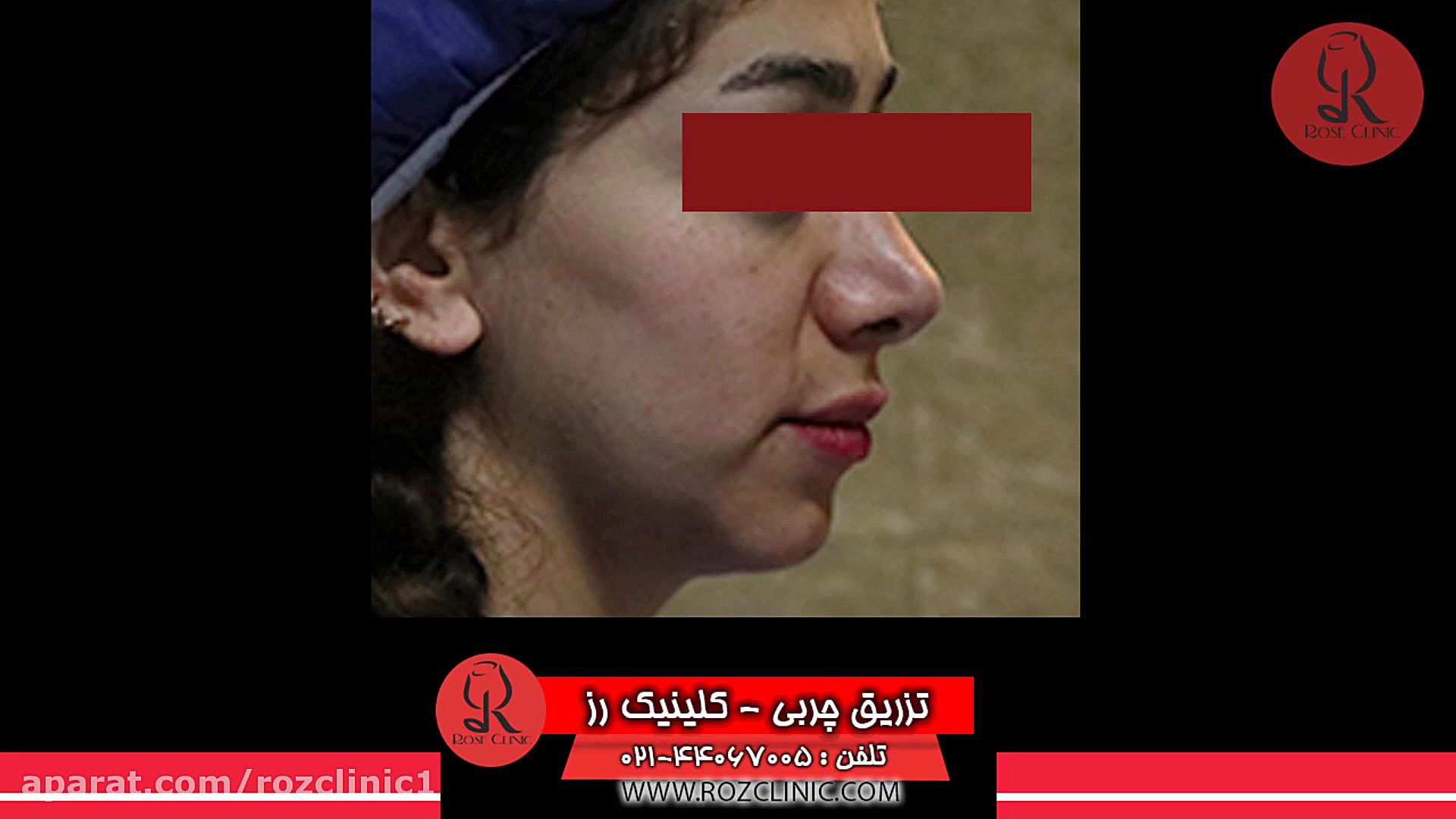 تزریق چربی | فیلم تزریق چربی | کلینیک پوست و مو رز | شماره43 دندانپزشکی کودکان