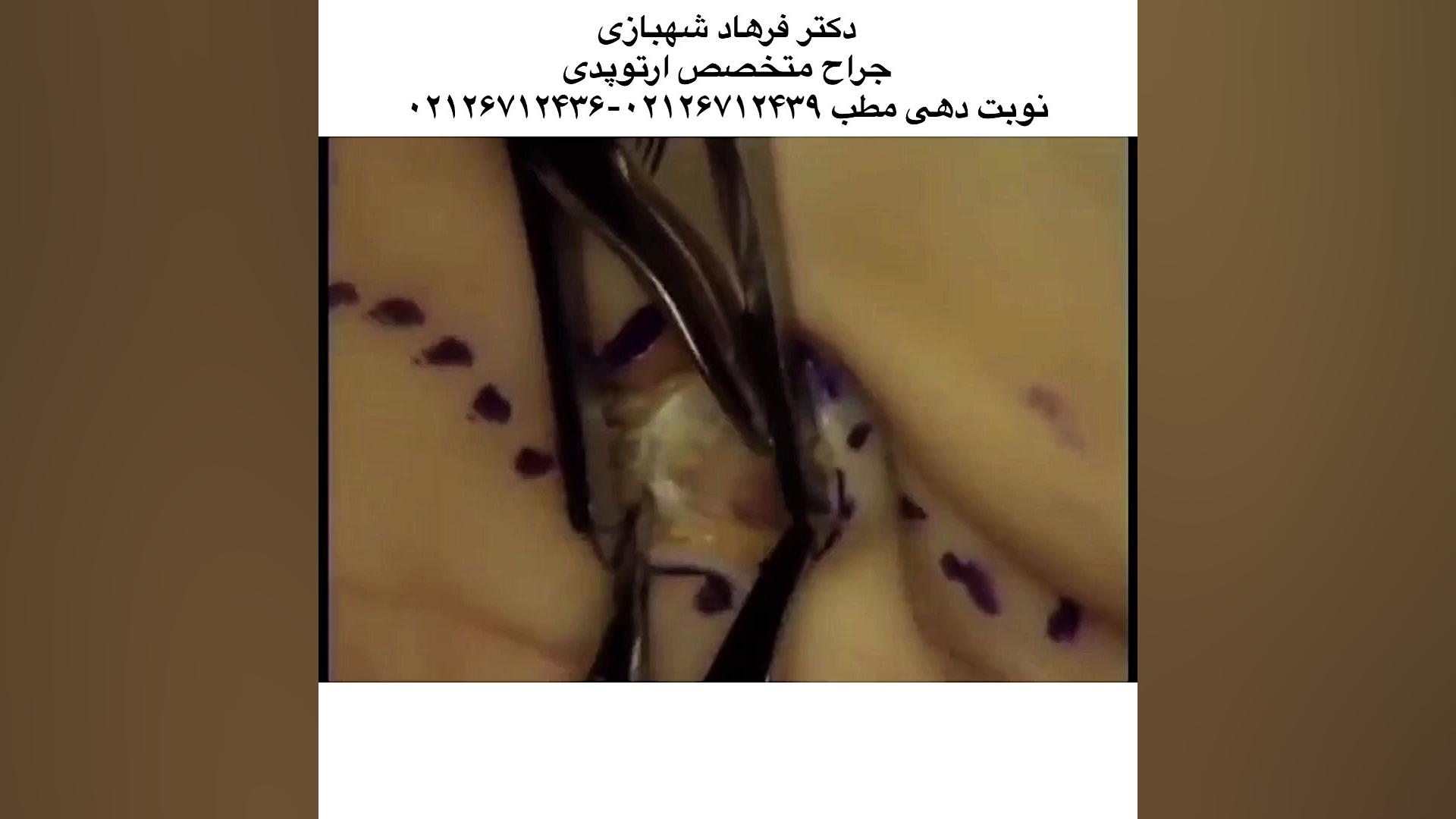 کلیپ پزشکی جراحی سندرم تونل کارپ دست،دکتر شهبازی،پزشک جراح متخصص ارتوپدی۲۶۷۱۲۴۳۹ منافذ باز پوست